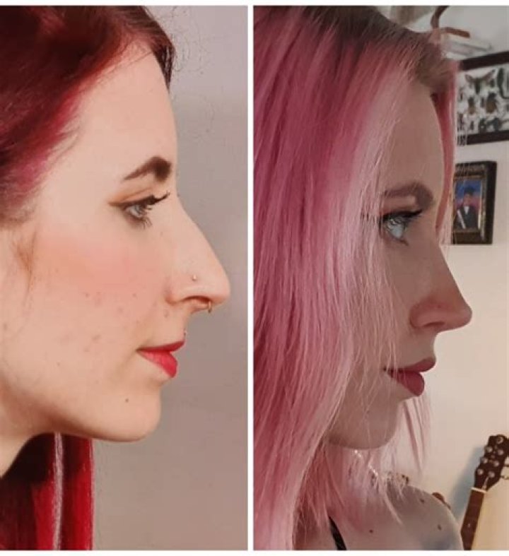 Bella Poarch Plastic Surgery