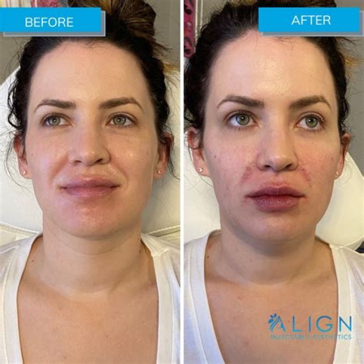 lisa-del-piero-before and after