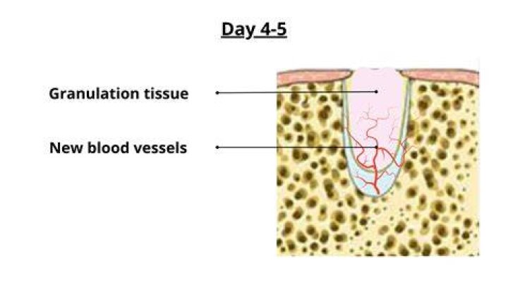 Recovery Period After Tooth Extraction